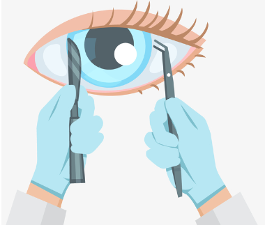 请问眼睛矫正手术有哪些方法？