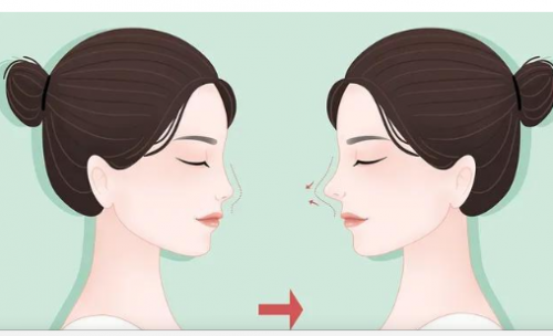 隆鼻假体取出术帮你将失败的鼻尖整形恢复原样
